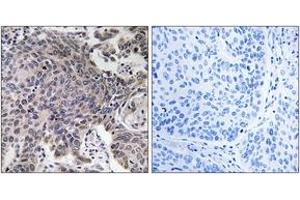 Immunohistochemistry analysis of paraffin-embedded human lung carcinoma tissue, using MRPL54 Antibody. (MRPL54 Antikörper  (AA 81-130))