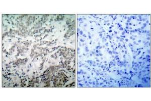 Immunohistochemical analysis of paraffin-embedded human breast carcinoma tissue using p53 (Ab-15) antibody (E021085). (p53 Antikörper)