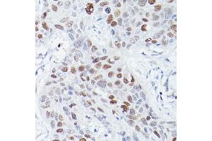 Immunohistochemistry of paraffin-embedded human lung squamous carcinoma tissue using RBPJK Rabbit mAb (ABIN1682563, ABIN3018511, ABIN3018512 and ABIN7101620) at dilution of 1:50 (40x lens). (RBPJ Antikörper)