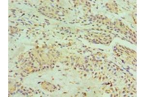 Immunohistochemistry of paraffin-embedded human breast cancer using ABIN7155132 at dilution of 1:100 (HNRNPM Antikörper  (AA 491-730))