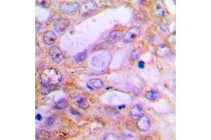 Immunohistochemical analysis of Caspase 12 staining in human lung cancer formalin fixed paraffin embedded tissue section. (Caspase 12 Antikörper  (Center))