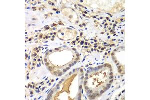 Immunohistochemistry of paraffin-embedded human gastric cancer using PSME2 antibody. (PSME2 Antikörper)