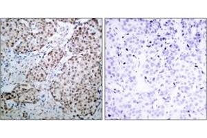 Immunohistochemistry analysis of paraffin-embedded human breast carcinoma, using p53 (Phospho-Ser315) Antibody. (p53 Antikörper  (pSer315))