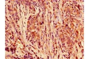 Immunohistochemistry of paraffin-embedded human pancreatic cancer using ABIN7150430 at dilution of 1:100 (POLR2C Antikörper  (AA 2-275))
