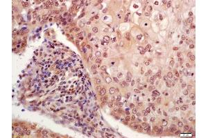 Formalin-fixed and paraffin embedded human laryngocarcinoma labeled with Anti-phospho-P53(Ser33) Polyclonal Antibody, Unconjugated (ABIN702925) at 1:200 followed by conjugation to the secondary antibody and DAB staining (p53 Antikörper  (pSer33))