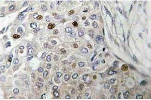 Immunohistochemistry (IHC) analyzes of p53 antibody in paraffin-embedded human breast carcinoma tissue. (p53 Antikörper)