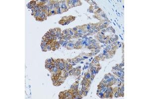 Immunohistochemistry of paraffin-embedded human gastric cancer using TOPBP1 antibody (ABIN5973403) at dilution of 1/100 (40x lens). (TOPBP1 Antikörper)