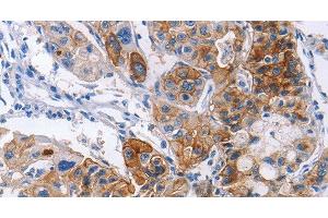 Immunohistochemistry of paraffin-embedded Human lung cancer using CD54 Polyclonal Antibody at dilution of 1:30 (ICAM1 Antikörper)