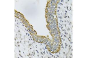 Immunohistochemistry of paraffin-embedded human uterine cancer using KRT5 Antibody (ABIN5971441) at dilution of 1/100 (40x lens). (Cytokeratin 5 Antikörper)