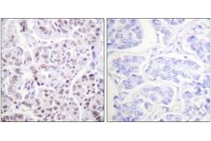 Immunohistochemistry analysis of paraffin-embedded human breast carcinoma tissue, using Histone H4 (Acetyl-Lys5) Antibody. (Histone H4 Antikörper  (acLys5))