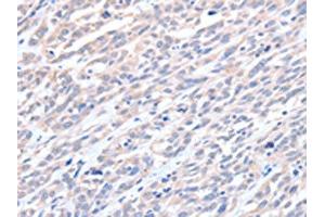 The image on the left is immunohistochemistry of paraffin-embedded Human esophagus cancer tissue using ABIN7128194(ACTL8 Antibody) at dilution 1/15, on the right is treated with fusion protein. (Actin-Like 8 Antikörper)