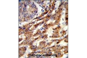 Formalin-fixed and paraffin-embedded human hepatocarcinoma reacted with ERGIC3 Antibody (N-term), which was peroxidase-conjugated to the secondary antibody, followed by DAB staining. (ERGIC3 Antikörper  (N-Term))