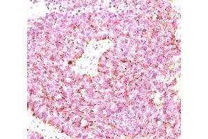IHC testing of human small cell lung carcinoma stained with chromogranin A antibody cocktail (clones LK2H10 + PHE5 + CGA414). (Chromogranin A Antikörper)