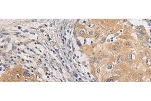 Immunohistochemistry of paraffin-embedded Human breast cancer tissue using AGAP3 Polyclonal Antibody at dilution of 1:25(x200) (AGAP3 Antikörper)