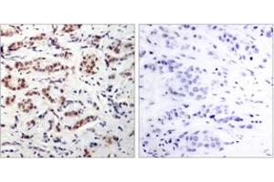 Immunohistochemistry analysis of paraffin-embedded human breast carcinoma, using STAT5A (Phospho-Tyr694) Antibody. (STAT5A Antikörper  (pTyr694))