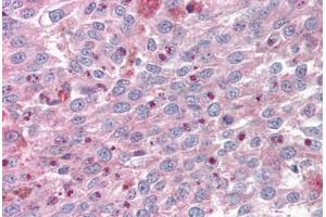 Anti-KLF4 antibody IHC staining of human melanoma. (KLF4 Antikörper  (AA 80-129))