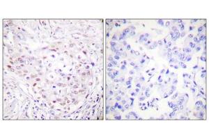 Immunohistochemistry analysis of paraffin-embedded human breast carcinoma tissue, using SENP3 antibody. (SENP3 Antikörper  (N-Term))