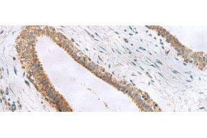 Immunohistochemistry of paraffin-embedded Human breast cancer tissue using CEMIP Polyclonal Antibody at dilution of 1:120(x200) (CEMIP Antikörper)