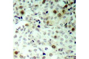 Immunohistochemistry of paraffin-embedded human breast carcinoma using Phospho-CDK2-T160 antibody (ABIN2987938). (CDK2 Antikörper  (pThr160))