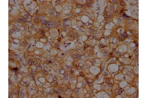 IHC image of ABIN7127636 diluted at 1:100 and staining in paraffin-embedded human liver cancer performed on a Leica BondTM system. (Rekombinanter N-Cadherin Antikörper)