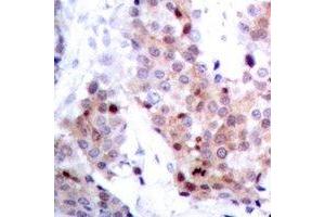 Immunohistochemical analysis of p53 staining in human breast cancer formalin fixed paraffin embedded tissue section. (p53 Antikörper)