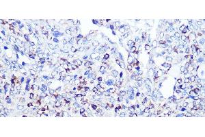 Immunohistochemistry of paraffin-embedded Human oophoroma using CD68 Polyclonal Antibody at dilution of 1:100 (40x lens). (CD68 Antikörper)