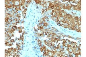 Formalin-fixed, paraffin-embedded human Melanoma stained with gp100 Mouse Monoclonal Antibody (PMEL/2038). (Melanoma gp100 Antikörper  (AA 376-502))