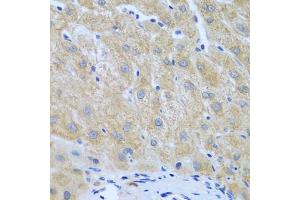 Immunohistochemistry of paraffin-embedded human liver cancer using FURIN antibody (ABIN5974735) at dilution of 1/100 (40x lens). (FURIN Antikörper)