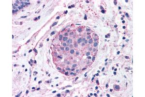 Anti-XPR1 antibody IHC of human Breast, Carcinoma. (xpr1 Antikörper  (N-Term))