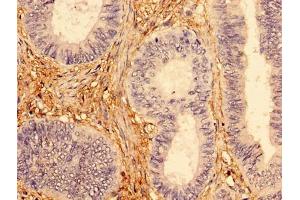 Immunohistochemistry of paraffin-embedded human colon cancer using ABIN7173954 at dilution of 1:100 (INPP5A Antikörper  (AA 1-409))