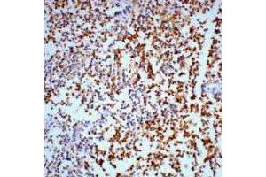 Immunohistochemical analysis of Gamma-enolase staining in human lung cancer formalin fixed paraffin embedded tissue section. (ENO2/NSE Antikörper)