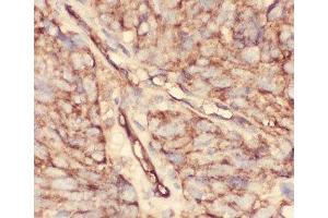 IHC-P: CD34 antibody testing of human lung cancer tissue (CD34 Antikörper  (AA 151-385))