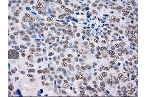 Immunohistochemical staining of paraffin-embedded Adenocarcinoma of colon tissue using anti-PSMD10mouse monoclonal antibody. (PSMD10 Antikörper)