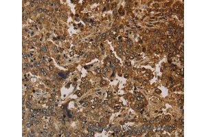 Immunohistochemistry of Human liver cancer using KRT16 Polyclonal Antibody at dilution of 1:30 (KRT16 Antikörper)