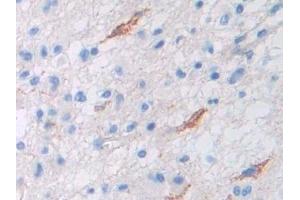 Detection of Pgp in Human Glioma Tissue using Polyclonal Antibody to Permeability Glycoprotein (Pgp) (Permeability Glycoprotein Antikörper  (AA 394-672))