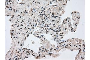 Immunohistochemical staining of paraffin-embedded Adenocarcinoma of breast tissue using anti-FERMT2 mouse monoclonal antibody. (FERMT2 Antikörper)