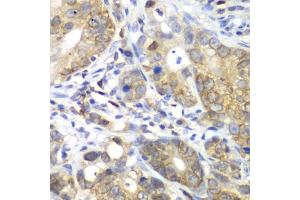 Immunohistochemistry of paraffin-embedded human gastric cancer using CDK1 antibody (ABIN6134274, ABIN6138303, ABIN6138304 and ABIN6219543) at dilution of 1:100 (40x lens). (CDK1 Antikörper  (AA 208-258))