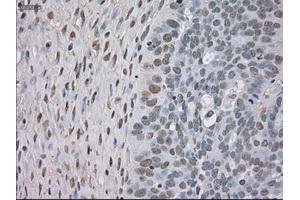 Immunohistochemical staining of paraffin-embedded Adenocarcinoma of colon tissue using anti-NTRK3mouse monoclonal antibody. (NTRK3 Antikörper)