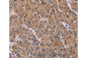 Immunohistochemistry of Human liver cancer using PPIF Polyclonal Antibody at dilution of 1:45 (PPIF Antikörper)