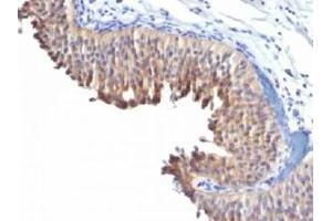 IHC testing of human bladder carcinoma with Keratin 10 antibody (clone LH2). (Keratin 10 Antikörper)