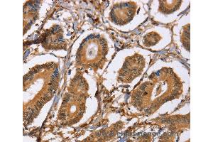 Immunohistochemistry of Human colon cancer using LXN Polyclonal Antibody at dilution of 1:25 (Latexin Antikörper)