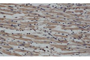 Immunohistochemistry of paraffin-embedded Human gasrtic cancer tissue using NOS2 Polyclonal Antibody at dilution 1:40 (NOS2 Antikörper)