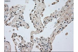 Immunohistochemical staining of paraffin-embedded Adenocarcinoma of breast tissue using anti-BUB1B mouse monoclonal antibody. (BUB1B Antikörper)