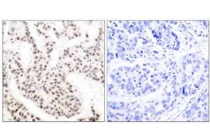 Immunohistochemical analysis of paraffin-embedded human breast carcinoma tissue using Elk-1 (phospho-Thr417) antibody (E011038). (ELK1 Antikörper  (pThr417))