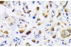 Immunohistochemistry of paraffin-embedded Human lung cancer using EP300 Polyclonal Antibody at dilution of 1:100 (40x lens). (p300 Antikörper)