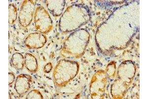 Immunohistochemistry of paraffin-embedded human gastric cancer using ABIN7142369 at dilution of 1:100 (MRPL2 Antikörper  (AA 61-305))