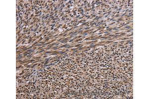 Immunohistochemistry of Human breast cancer using KIF2A Polyclonal Antibody at dilution of 1:30 (KIF2A Antikörper)