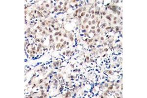 Immunohistochemistry (IHC) image for anti-Cyclin-Dependent Kinase Inhibitor 1B (p27, Kip1) (CDKN1B) (pThr187) antibody (ABIN3020148) (CDKN1B Antikörper  (pThr187))