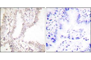 Immunohistochemical analysis of paraffin-embedded human lung carcinoma tissue using Prostate Apoptosis Response Protein-4 antibody. (PAWR Antikörper)