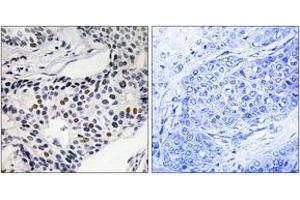 Immunohistochemistry analysis of paraffin-embedded human breast carcinoma, using WEE1 (Phospho-Ser53) Antibody. (WEE1 Antikörper  (pSer53))